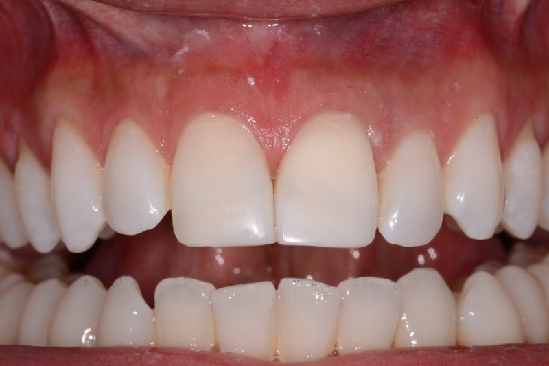 After tooth whitening and white fillings