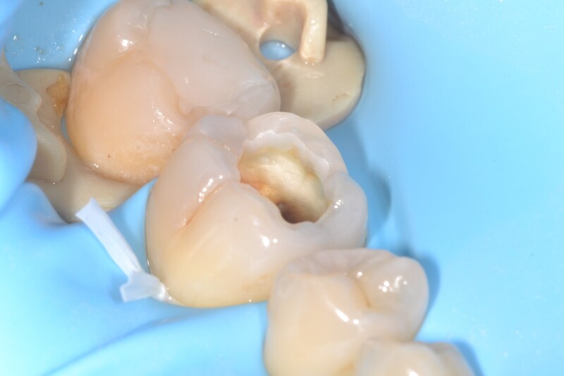 Tooth Decay before treatment