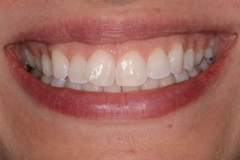After ICON white spot removal treatment at Hainault Gentle Dental