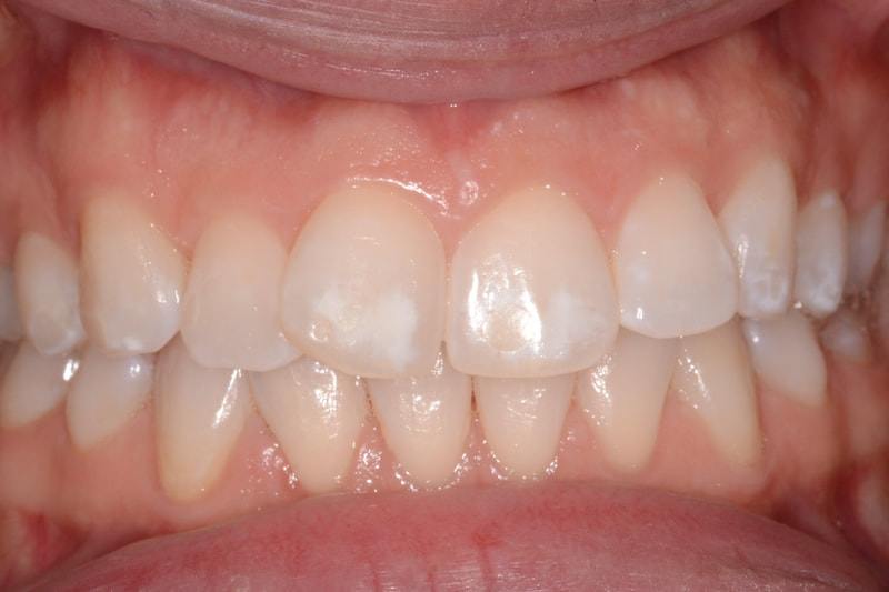 Removal of white spots on teeth with ICON resin infiltration at Hainault Gentle Dental