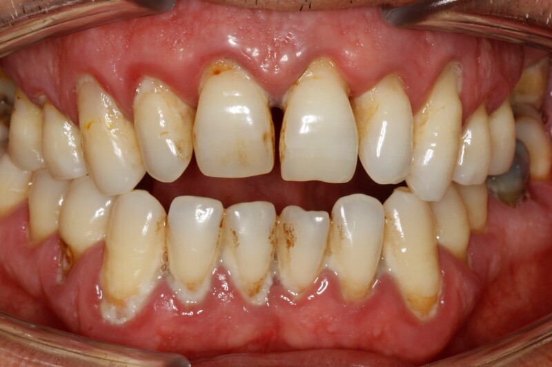 Before stain removal and hygiene cleaning by Hainault Gentle Dental Care